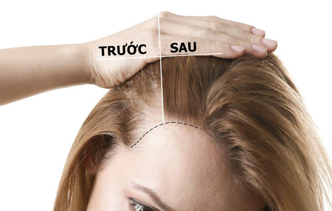 Thuốc để mọc tóc có thực sự mang lại hiệu quả?